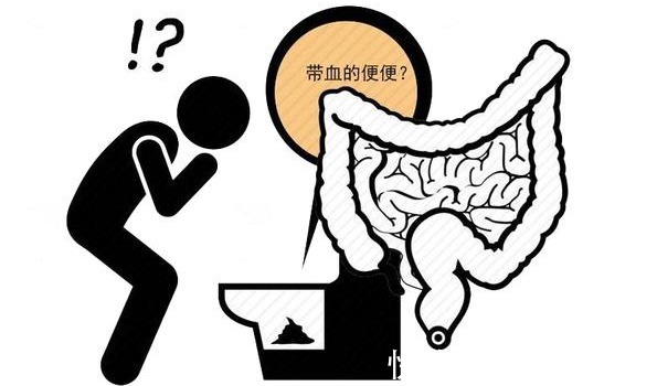 身体|肠癌一发现就是晚期?医生:身体有4种“异常”,是肠道“求救”