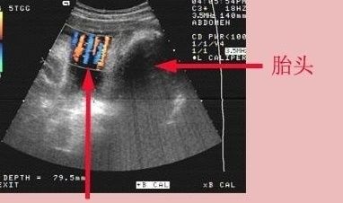 怀孕36周脐带绕颈3圈，羊水又偏少，该怎么办？