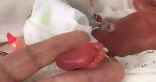 身体机能|母亲在怀孕期间长时间没有体重增加,婴儿只有268克,成为世界上最小的男孩