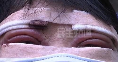 费用|女子7万元做双眼皮，额外收费加项导致费用20万，女子：打了9支除皱针