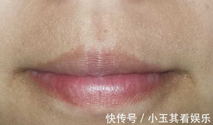 美白|嘴唇周围发黑是怎么回事?如何美白呢?