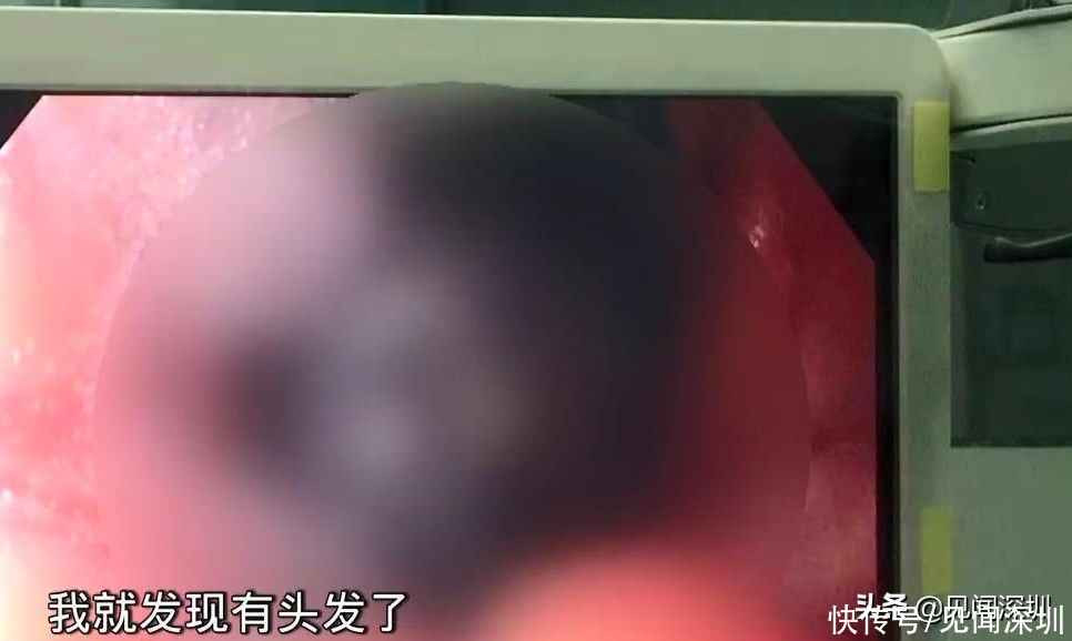 不良习惯|深圳8岁小女孩，经常腹痛食欲不振，医生发现她竟在吃这东西