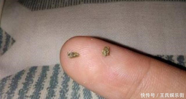 臭味|孩子被嘲笑“嘴太臭”,被同学孤立,医生取出小颗粒,宝妈都嫌臭