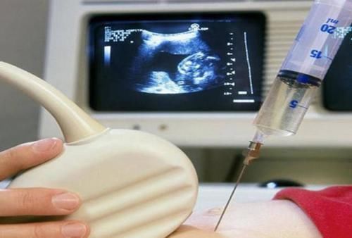 性别|孕期想知道“胎儿性别”?这些方法可以测出,民间的说法不可信