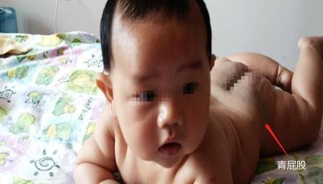 屁股|宝宝身上有淤青是来给父母报恩的如果胎记长成这样,家长要重视