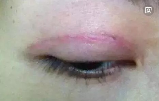 手术|手术割了双眼皮的人,老了之后有什么影响看完真要留意了