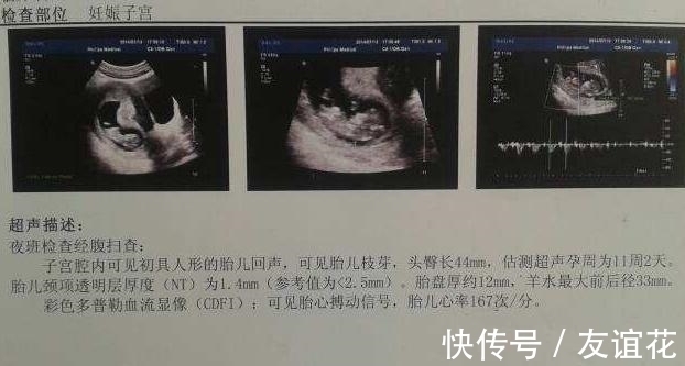 性别|四维彩超上的“信息”可能暗示了宝宝的“性别”,孕妈了解一下