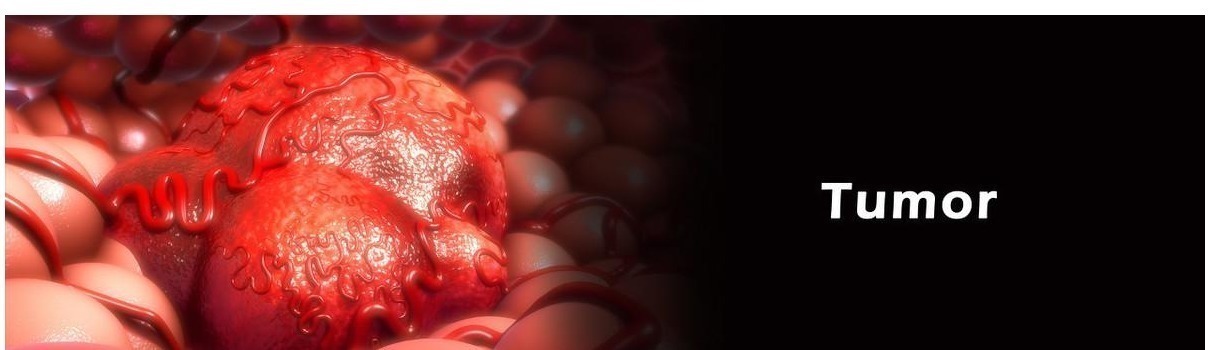 鼻炎|以为是鼻炎,结果查出来鼻息肉!会不会癌变,要不要手术切掉