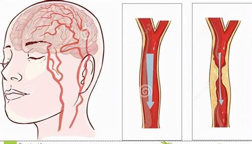 stroke|花生真能“养血管”？医生：7万多人追踪15年，确定最佳花生用量