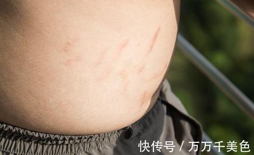 肚子|孕妇肚子上有条黑线,是什么原因呢?需要祛除么?
