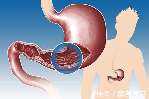 对症治疗|慢性胃炎和十二指肠炎,该如何应对?这6点建议能让你的胃好起来