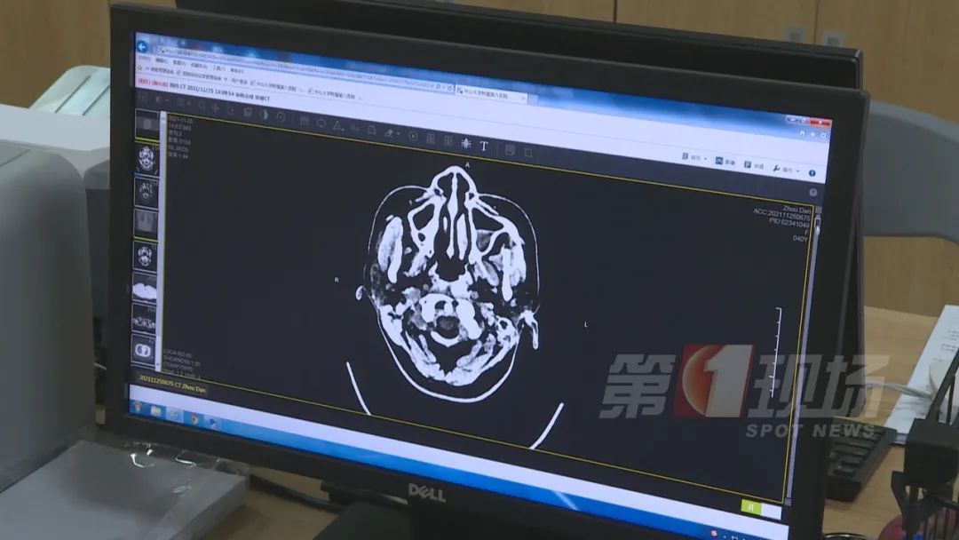 习惯|秋冬高发！年轻人“中风”更危险，有这些习惯的注意了...