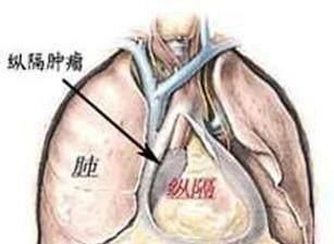 体检|55岁男子，体检正常5个月后查出晚期肺癌去世体检到底有何用