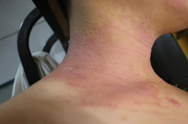 宝宝|宝宝患有特应性皮炎，家长日常如何防护？