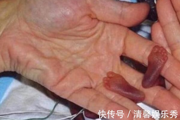 医生们|18年前那个出生时仅25厘米,体重半斤的女婴,如今变化太大了!