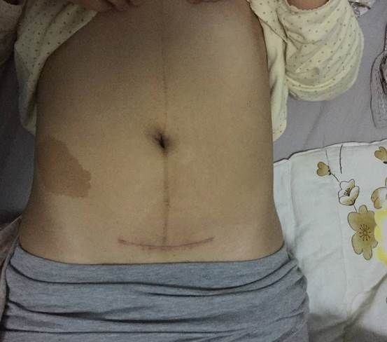 性生活|剖腹产的伤口,对女性身体会不会产生伤害,妇产科医生说出真相