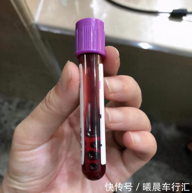 nt|世界唐氏综合征日:三类孕妇易怀“唐氏儿”,两项产检筛查很关键