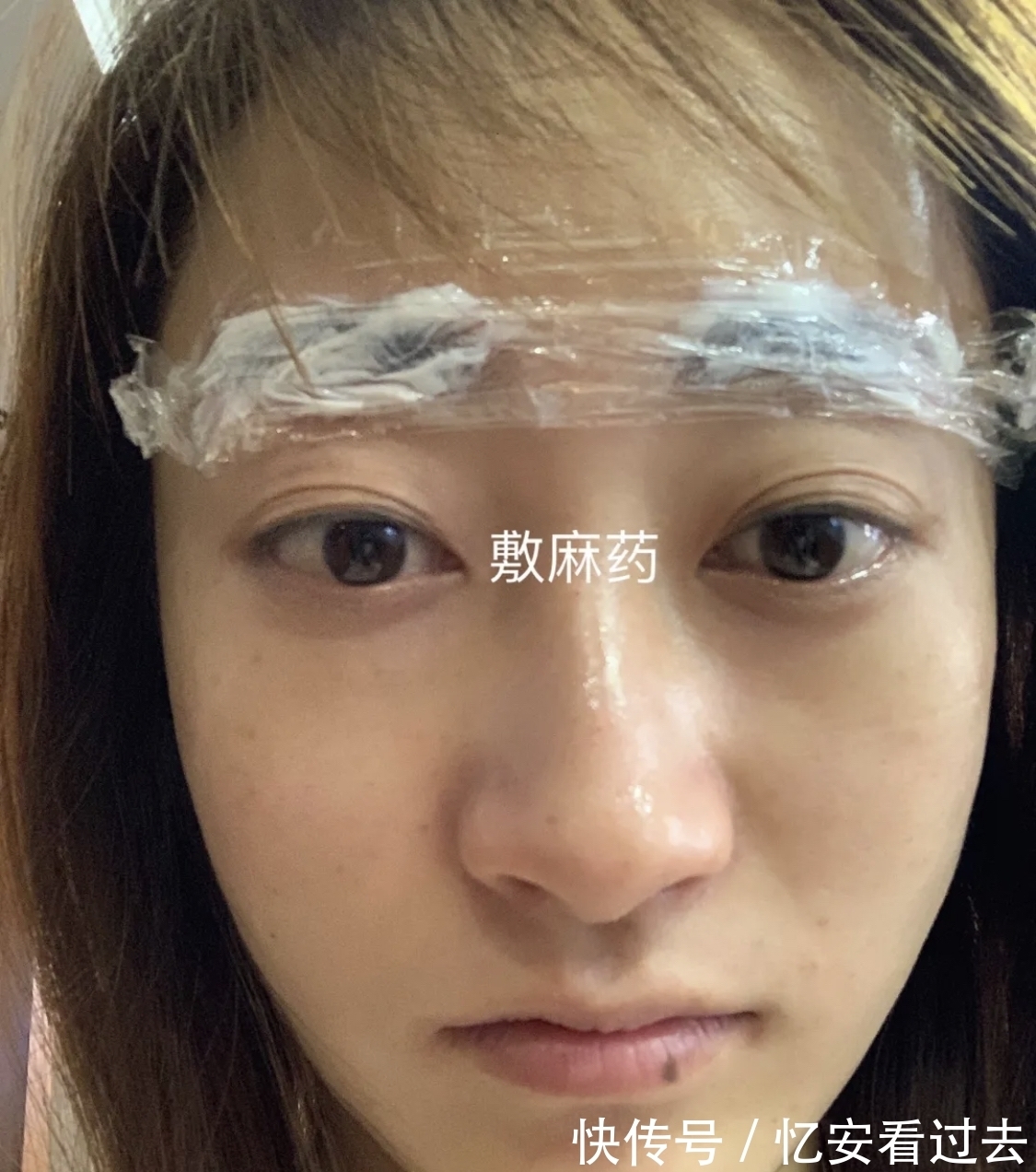 项目|别以为秒杀的医美项目是赚到!