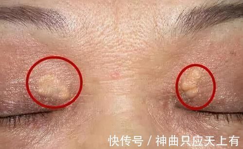 溶栓|“溶栓高手”公布,并非苦瓜,平时敞开吃,血管干净,远离头晕手麻