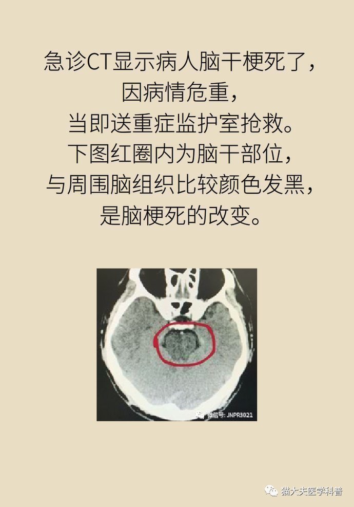 血脂|血压血脂都正常,30岁的他为啥也得了脑卒中?