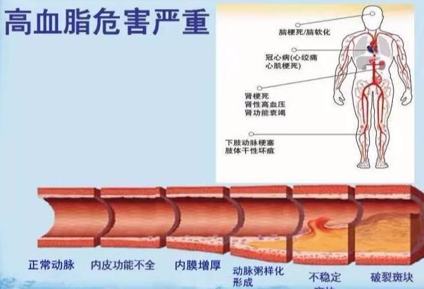 高脂蛋白血症|有7种表现可能血脂高了，医生提醒7项措施做好，保证血管顺畅
