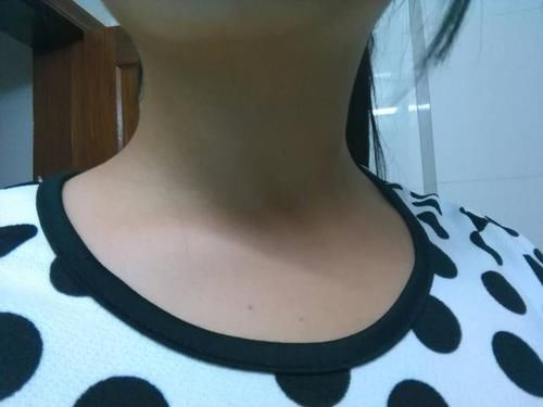 结节|体内有肿瘤，看脖子就知道？脖子有这2种“迹象”，说明出问题了