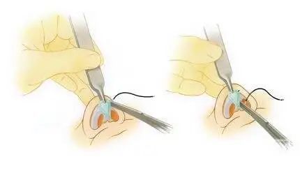 特点|耳软骨(自体)隆鼻的7个特点丨科普篇