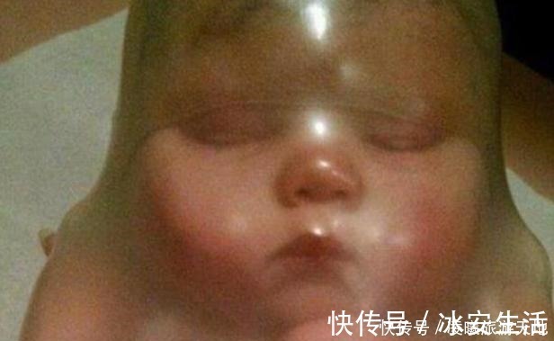 分娩|90后孕妇生下“带壳宝宝”,丈夫情绪失控,医生却说是个幸运儿