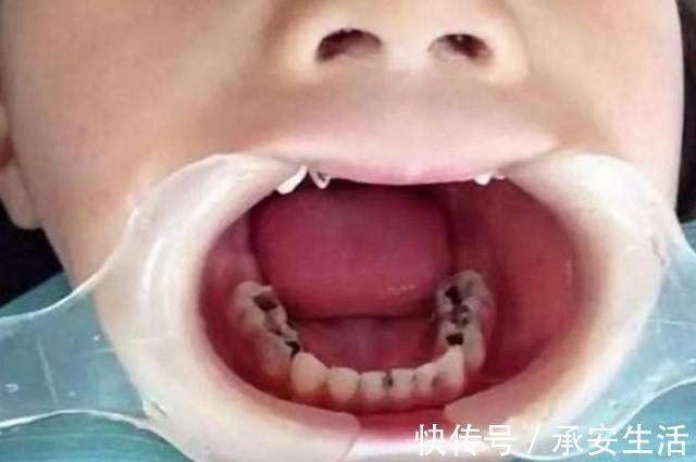 牙齿|3岁的孩子满口“小黑牙”?罪魁祸首不是糖,而是父母无知惹的祸