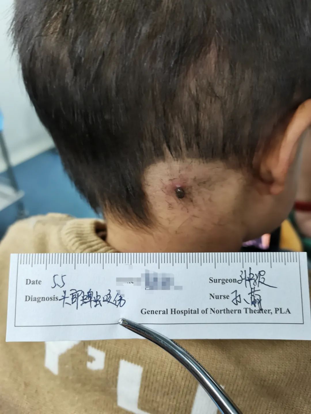 刘中波|2岁小孩被蜱虫吸血多天,虫子涨大几十倍,取下来还活着