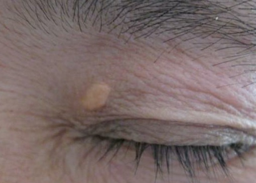 血脂升高|血脂高不高,看脸上三个地方就知道,降血脂四种食物一口别吃