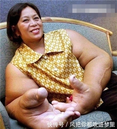 脂肪|女子手臂比大腿还粗,手臂上的脂肪切除掉还是会长出来