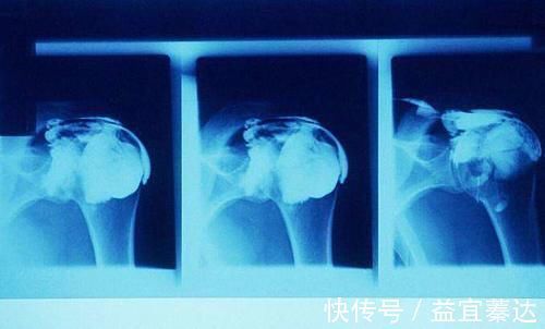 肌肉痉挛|肩膀疼痛难受?不一定是肩周炎!还可能和3种疾病有关,别搞错了