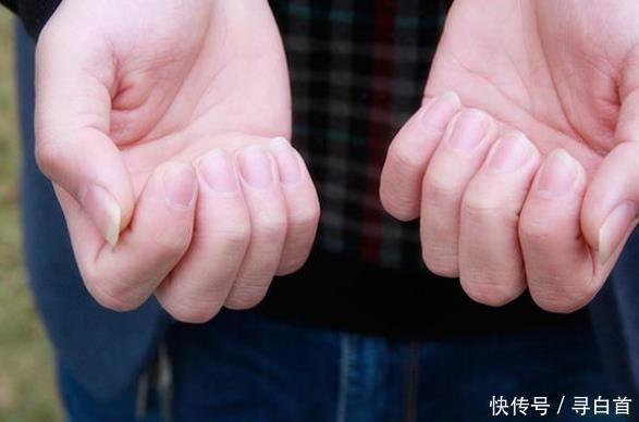 变化|指甲上没“月牙”就是身体不好指甲若没4种变化,说明身体不错