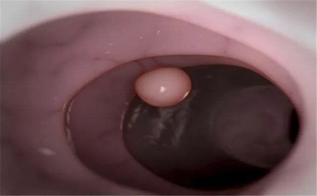 艾灸|大家好!我叫“息肉”,癌症的近亲!我最怕无情又温柔的手术刀艾灸