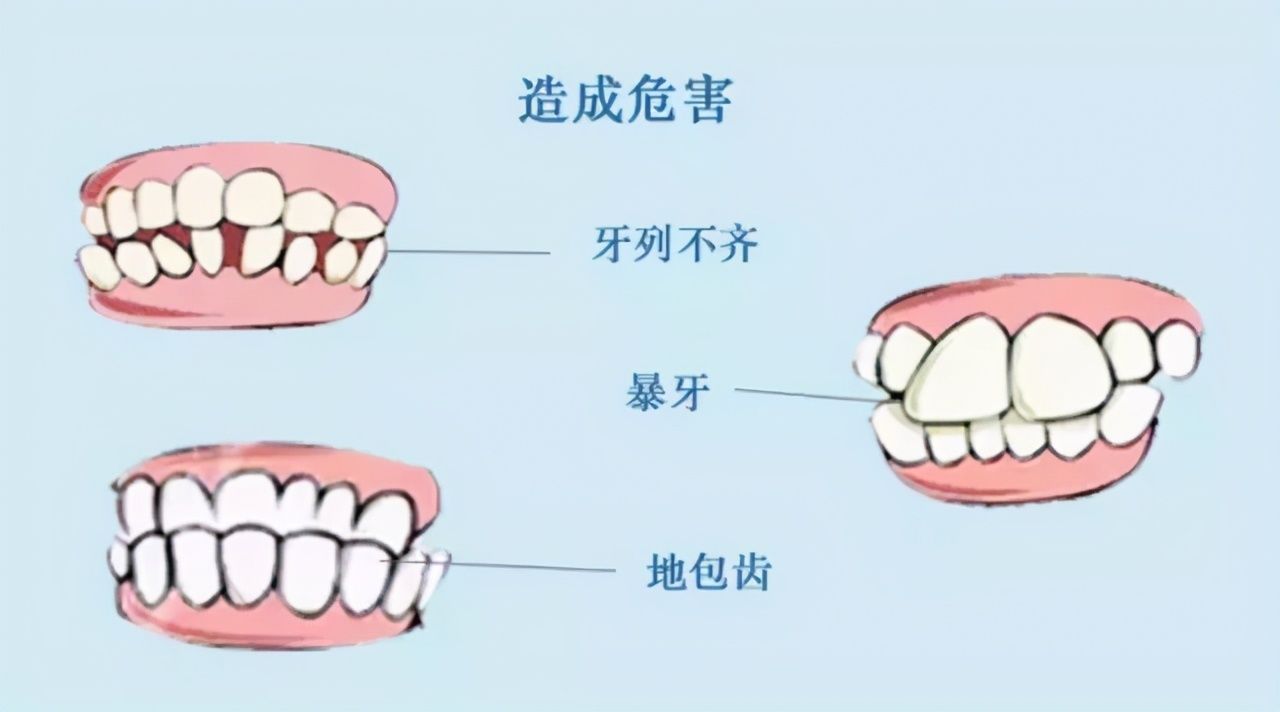 乳牙过早脱落|孩子换牙期间的注意事项，这几点家长一定要注意