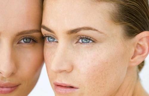 麻醉|激光祛斑会不会反弹,费用与手术流程是什么?