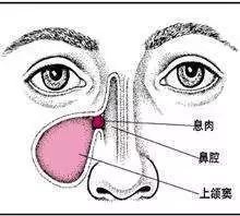 胃息肉|长大后,它就成了癌!到底要多久?看完这篇,了解息肉的全部