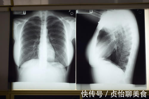 检查|胸片检查中经常出现的“肺纹理增粗”、“肺纹理增重”,严重吗?