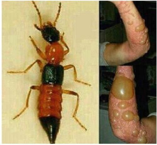 妈妈|两个月婴儿全身溃烂有脓,妈妈称家里不关窗,被“毒虫”趁虚而入