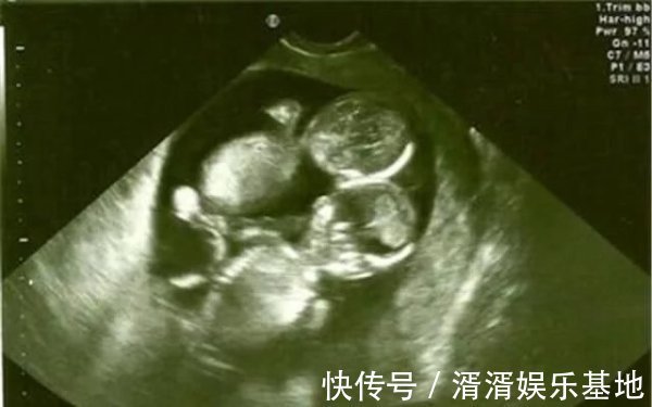 引产|备孕4年怀上双胞胎,孕检却说是连体婴,妈妈坚持生下后相拥而泣