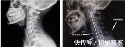 颈椎|颈椎病反复不好,一样小物就能解决,身边有颈椎病的可以保存了!