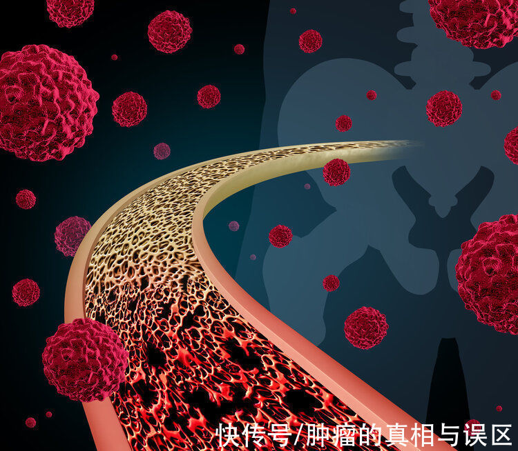 肿瘤|癌症转移速度有多快？为啥有人很快就转移了？或和4个原因有关