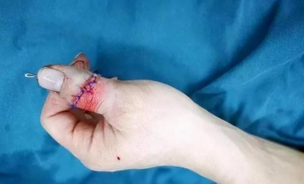 父母|6岁小孩永远失去了手指,只因父母处理不当,这个常识应该知道
