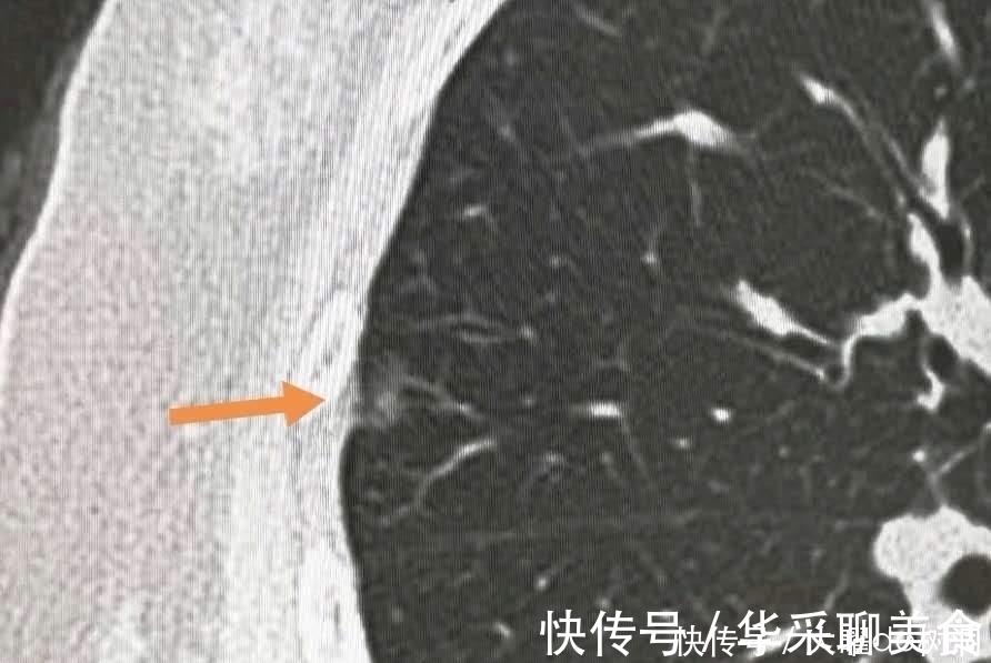 体检|年年体检，为什么还得了晚期肺癌？体检有啥用！