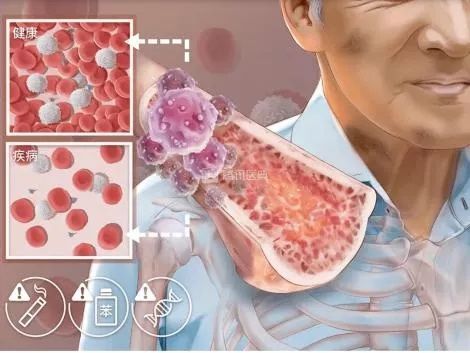 造血干细胞|病态疲乏,当心悄悄发生的骨髓“慢急症”,好发于长期暴露在危险因素下的老年人!