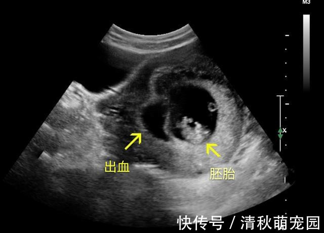 阴超|怀孕多久做B超检查比较好?这份孕早期检查攻略,孕妈们查收学习