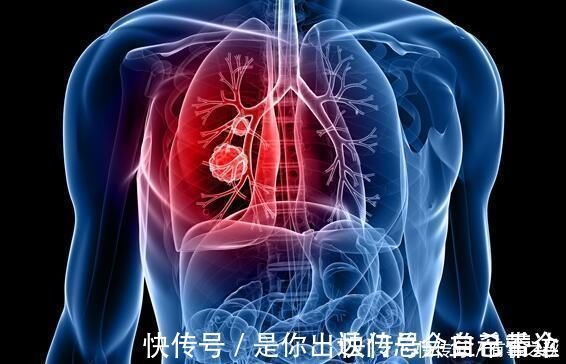 感冒|出现这种咳嗽, 别以为是感冒问题, 它可能是肺癌发出的信号!
