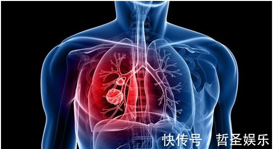 癌症|肺癌患者学习晚期癌症扩散后,做几件事就能保住你的命
