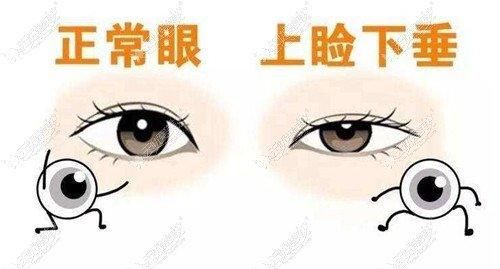 提眉可以改善上睑下垂的问题吗？